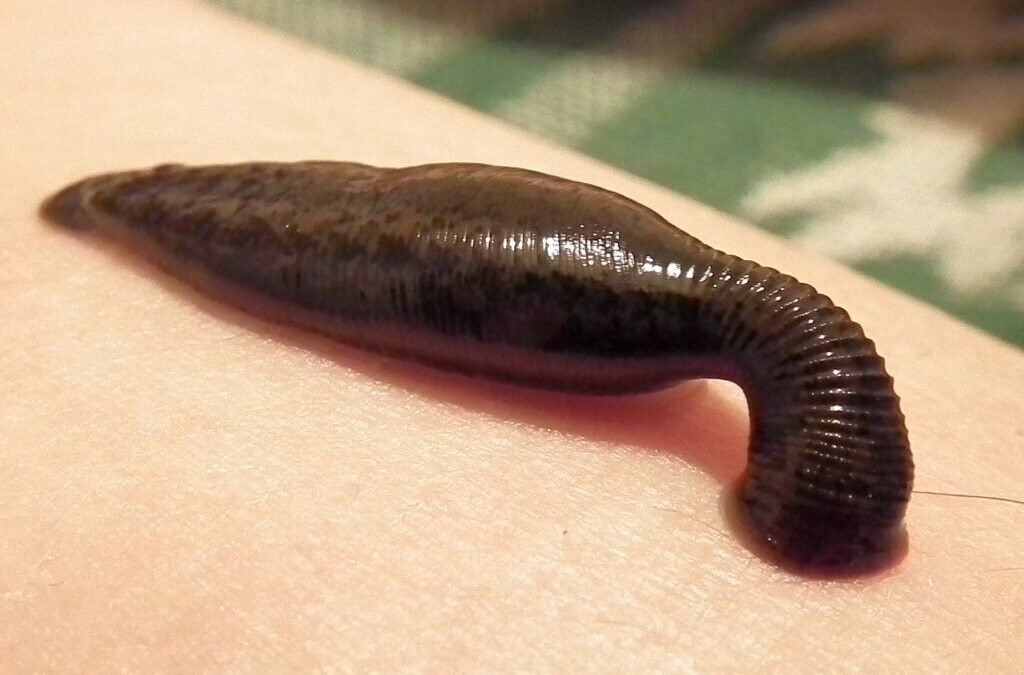 LEECH THERAPY (JALAUKAAVACHARANA)